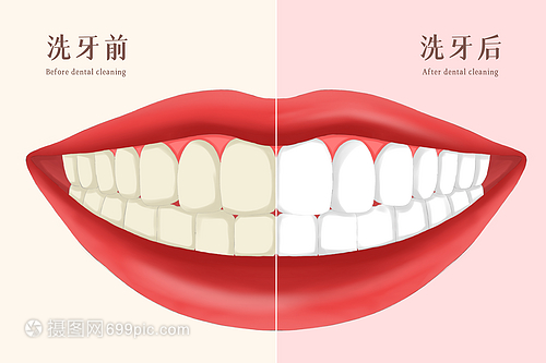 牙齒美容之洗牙前后對(duì)比插畫(huà)