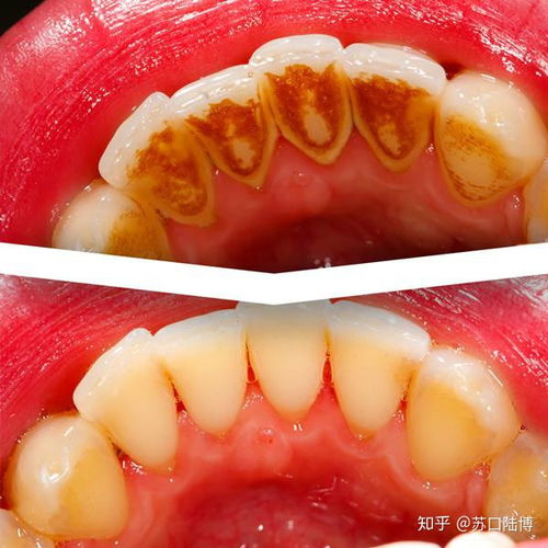 有什么好的可以有效美白牙齒的方法嗎